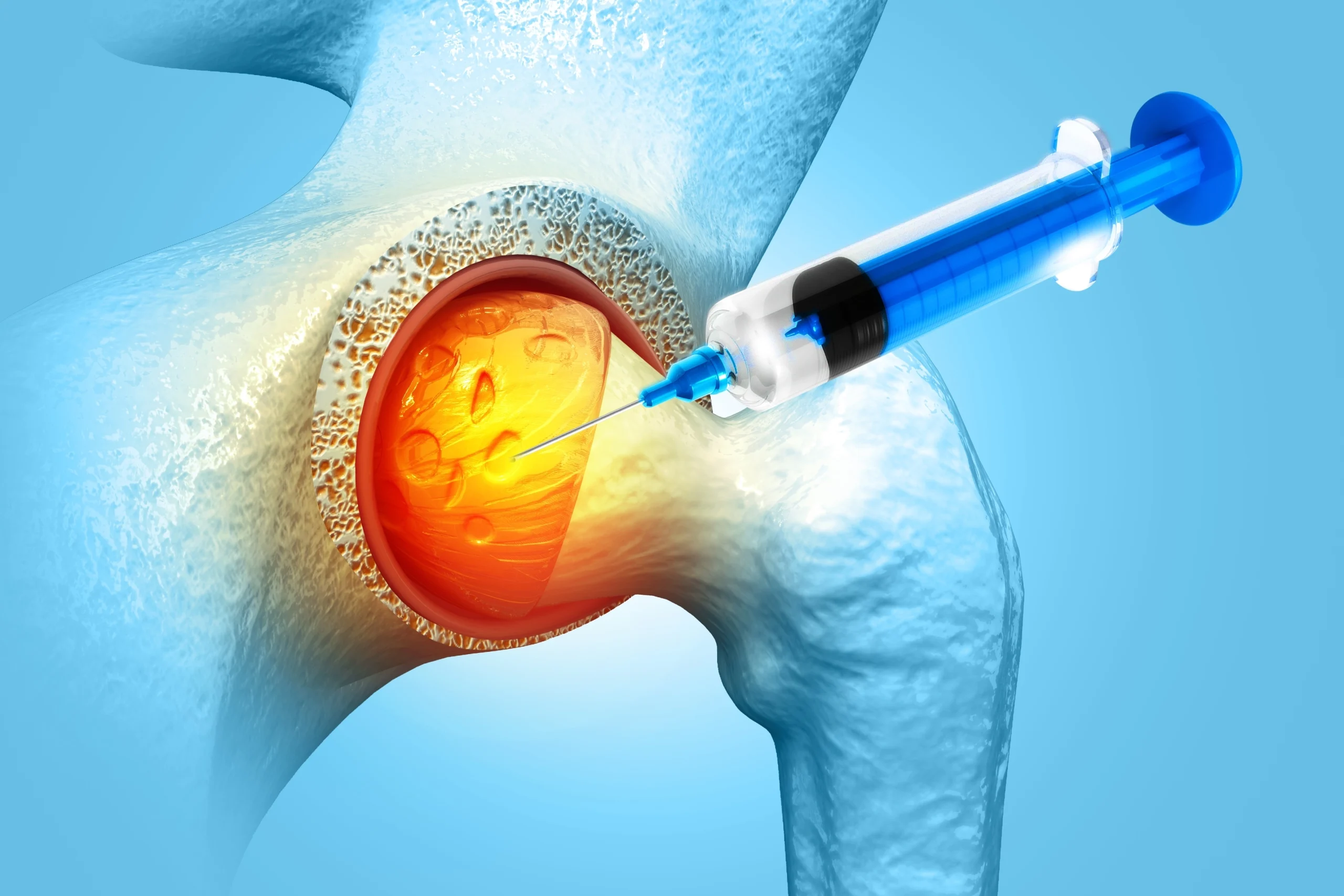 How Often Can You Get Hip Corticosteroid Injections?